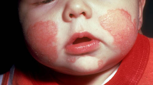 Click image for larger version

Name:	eczema111.jpg
Views:	1
Size:	25.6 KB
ID:	1302124