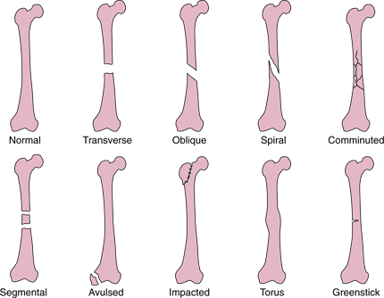 Click image for larger version

Name:	common-types-of-fracture-lines.gif
Views:	1
Size:	20.7 KB
ID:	1302221