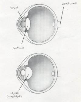 Click image for larger version

Name:	cataract1.jpg
Views:	1
Size:	7.5 KB
ID:	1357456